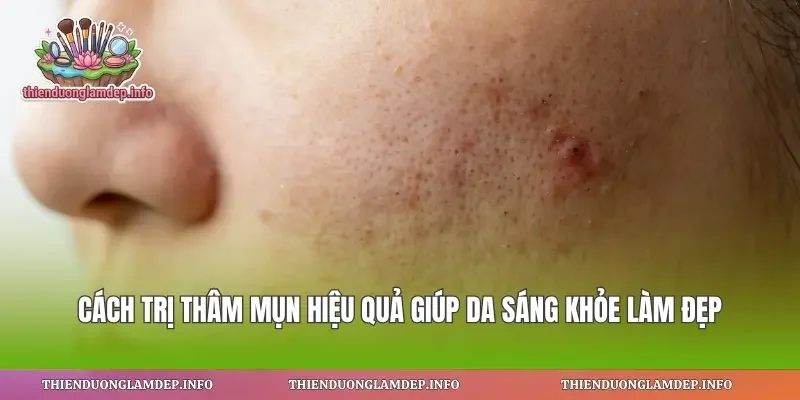 Cách Trị Thâm Mụn Hiệu Quả