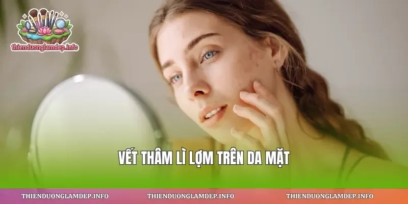 Vết thâm lì lợm trên da mặt